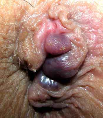 HEM8-hemorrhoids-hemroids-suspect-internal-and-external.jpg