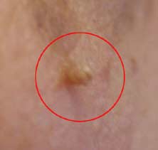 Typical appearance of a treatable skin tag