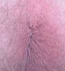 This picture of external hemorrhoids shows that they don't always show themselves - no straining