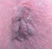 External hemorrhoids that appear with much straining