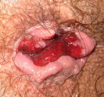 These are external bleeding hemorrhoids that are diagnosed as Grade 4 - reuiring surgery for removal
