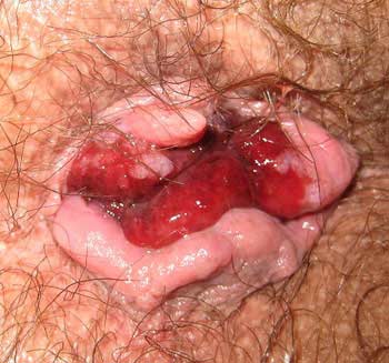 Hemorrhoid Anal Sex 40