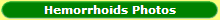 Hemorrhoids pictures and photos