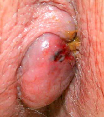 treatment for bleeding external hemorrhoids