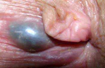 External thrombosed hemorrhoid, skin tag on the right.