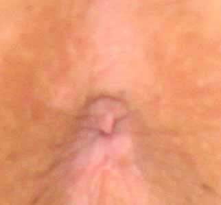 This picture of an external  hemroid following pregnancy and childbirth.