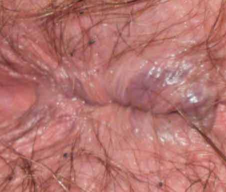 bumps around Itch area in anus the