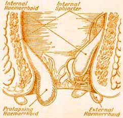 This picture / diagram of hemroids, shows what external, internal and prolapsed internal hemorrhoids