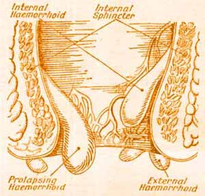 This piles picture shows the major types of piles. Unless you are taking pills, you need to know what sort of piles you have, so that you can choose the appropriate treatment.