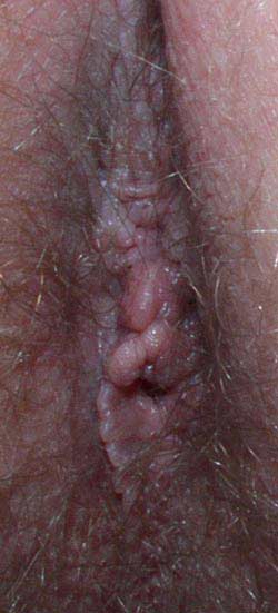 The same hemorrhoids after using Neo Healar for 5 weeks.