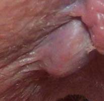 External hemorrhoid and a harmless skin flap