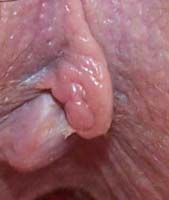 The second picture of the external hemorrhoid and skin flap