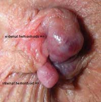 prolapsed internal hemorrhoid, pile, hemroid, haemorrhoid