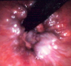 Internal hemorrhoids as found under a sigmoidoscope examination