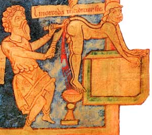 HEMROIDS - An 11th century picture of a hemroid operation